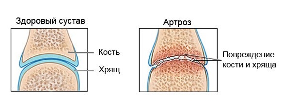 Проблема артроза сустава