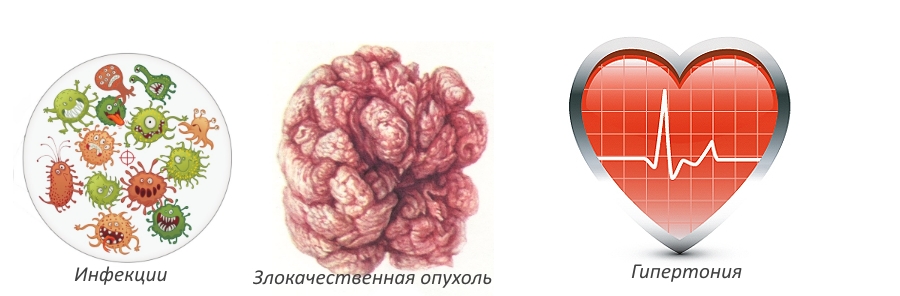 Противопоказания для массажа при грыже поясницы