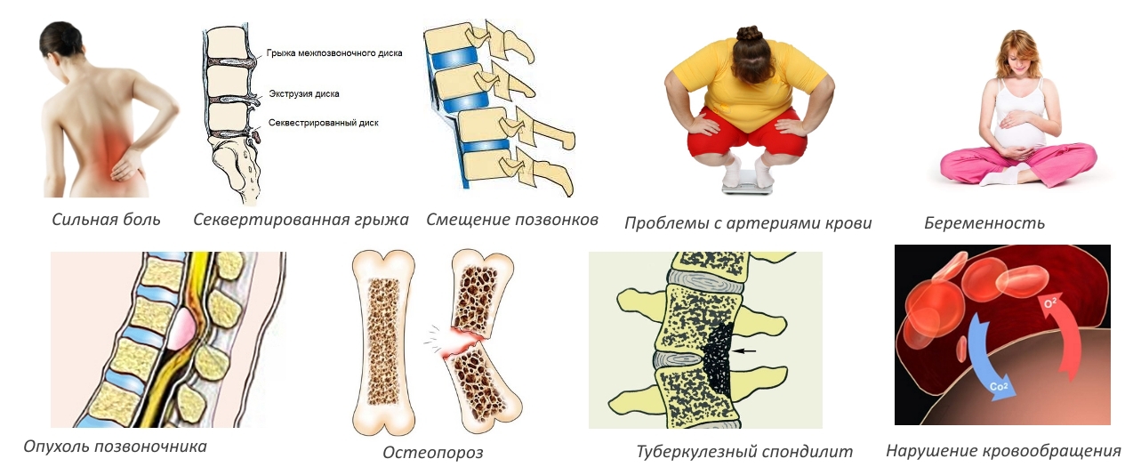 Противопоказания для вытягивания позвоночника