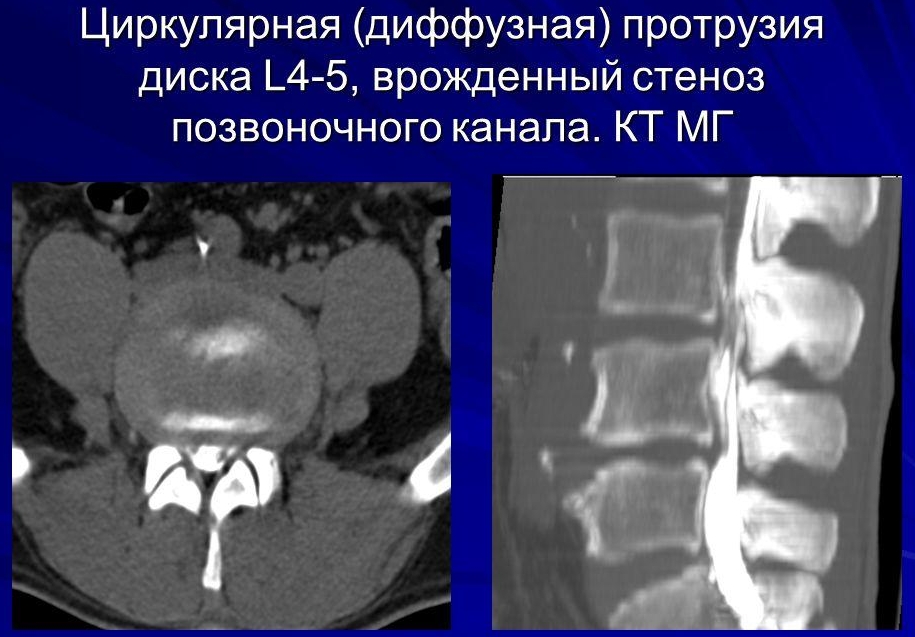 Циркулярная протрузия диска на снимке