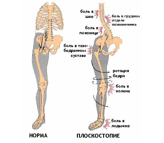 Проявление плоскостопия