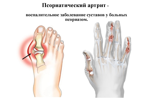 Псориатический артрит