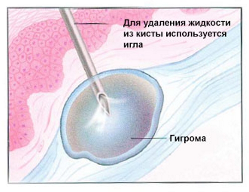 Пункция гигромы