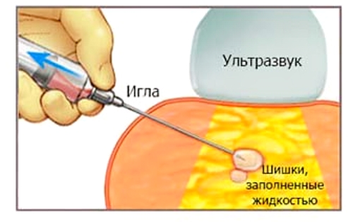 Пункция кисты пятки