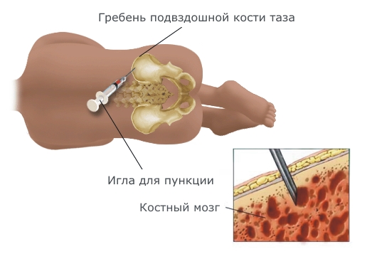 Пункция кости