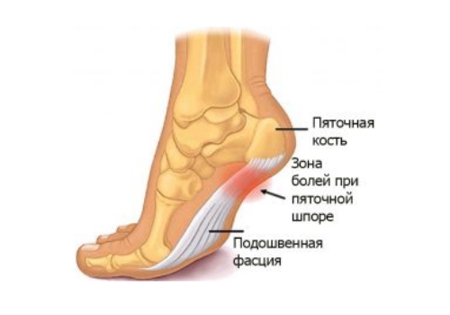 Пяточная шпора 