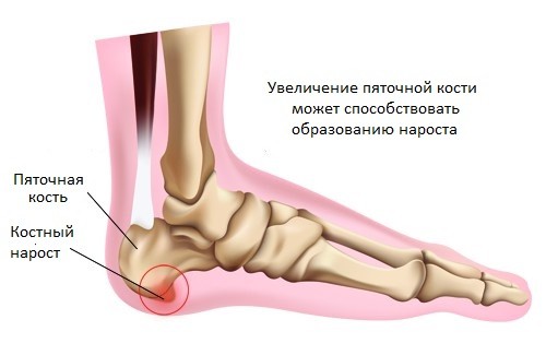 Пяточная шпора