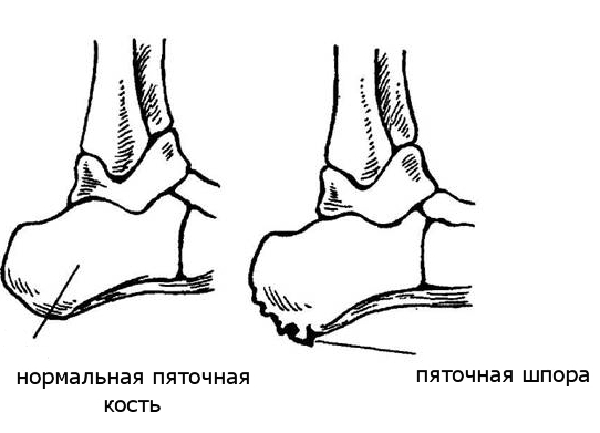 Пяточная шпора