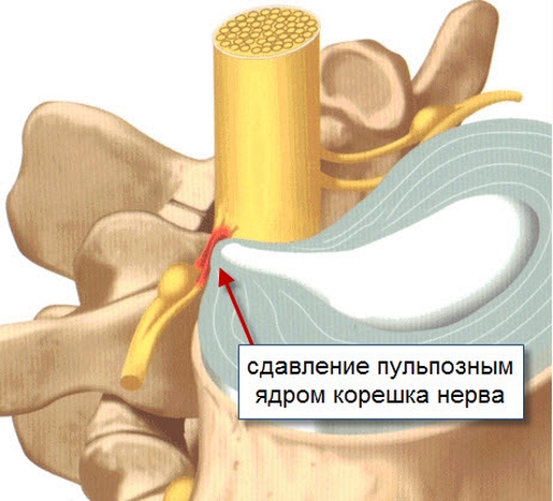 Радикулит грудного позвонка