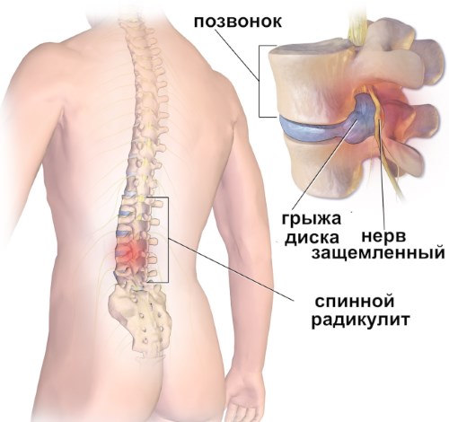 Радикулит