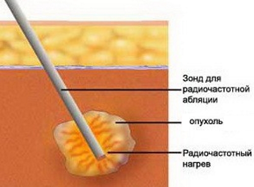 Радиочастотная абляция остеомы