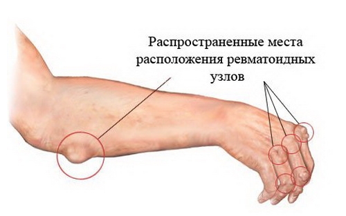 Расположение ревматоидных узлов
