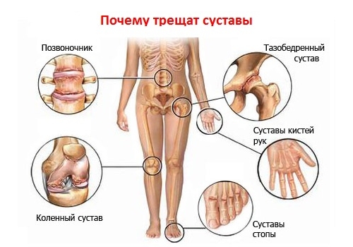 Распространение артроза