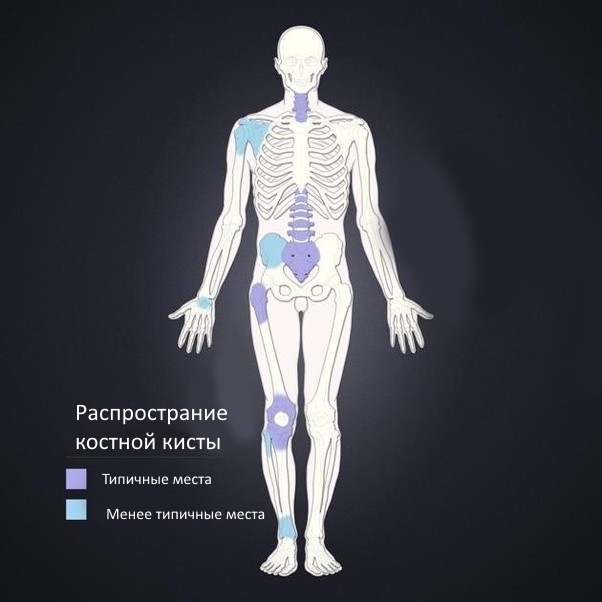 Типичные места распространения костной кисты
