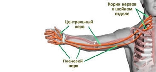 Распространение неврита по всей руке