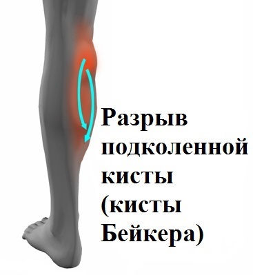 Отек голени при разрыве кисты
