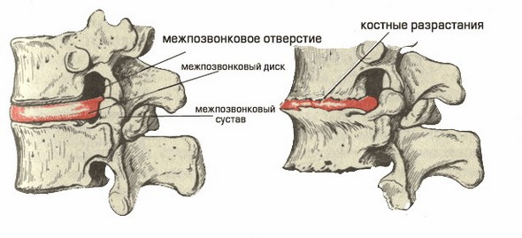 Костные разрастания при хондрозе