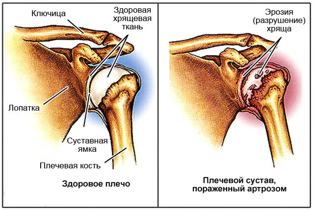 Разрушение плечевого сустава при артрозе