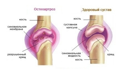 Разрушение сустава при остеоартрозе