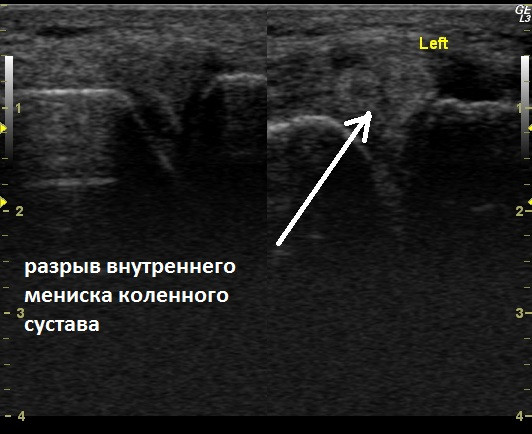 Разрыв мениска коленного сустава на УЗИ