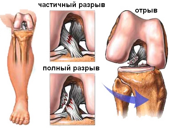 Разрыв передней крестообразной связки