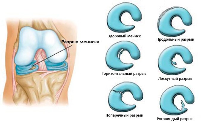 Разрывы мениска
