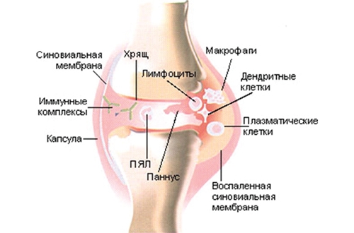 Реактивный артрит