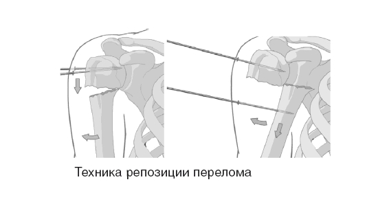 Репозиция при переломе плечевой кости