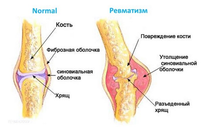 Ревматизм
