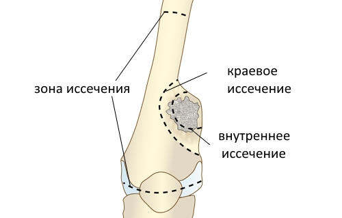 Резекция саркомы