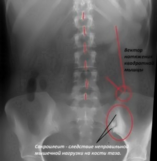Левосторонний сакроилеит на рентгене