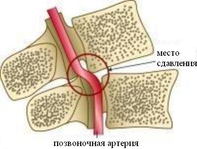 Головокружение из-за сдавливания кровеносных сосудов