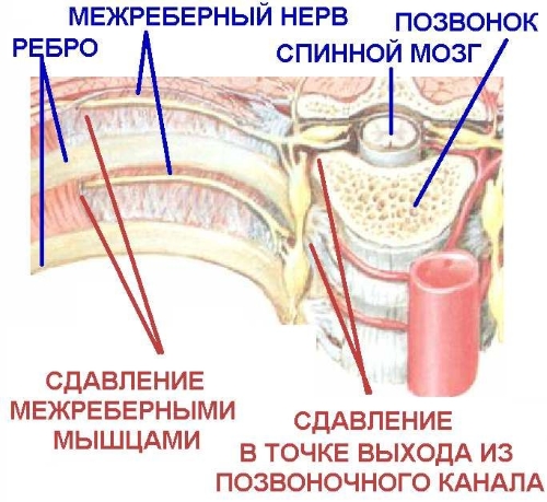Сдавливание межреберных нервов