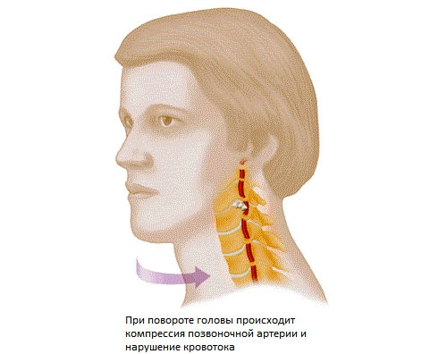 Сдавливание позвоночной артерии
