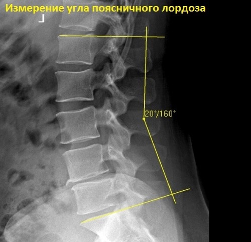 Сглаженный лордоз рентген