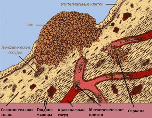 Рак кости