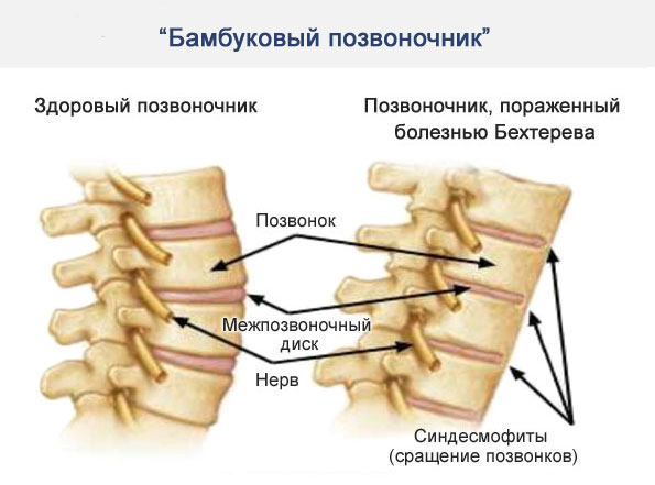 Симптом бамбуковой палки