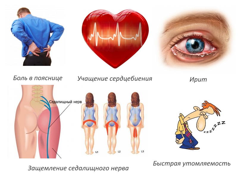 Симптомы при болезни Бехтерева
