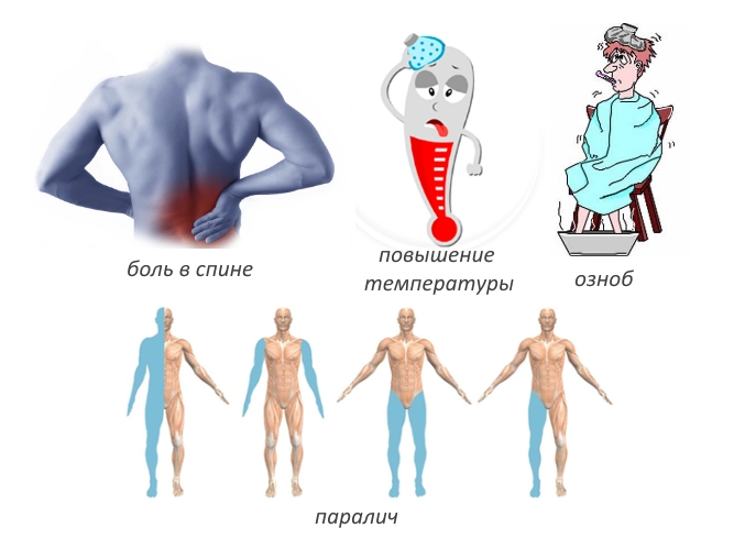 Симптомы эпидурального абсцесса