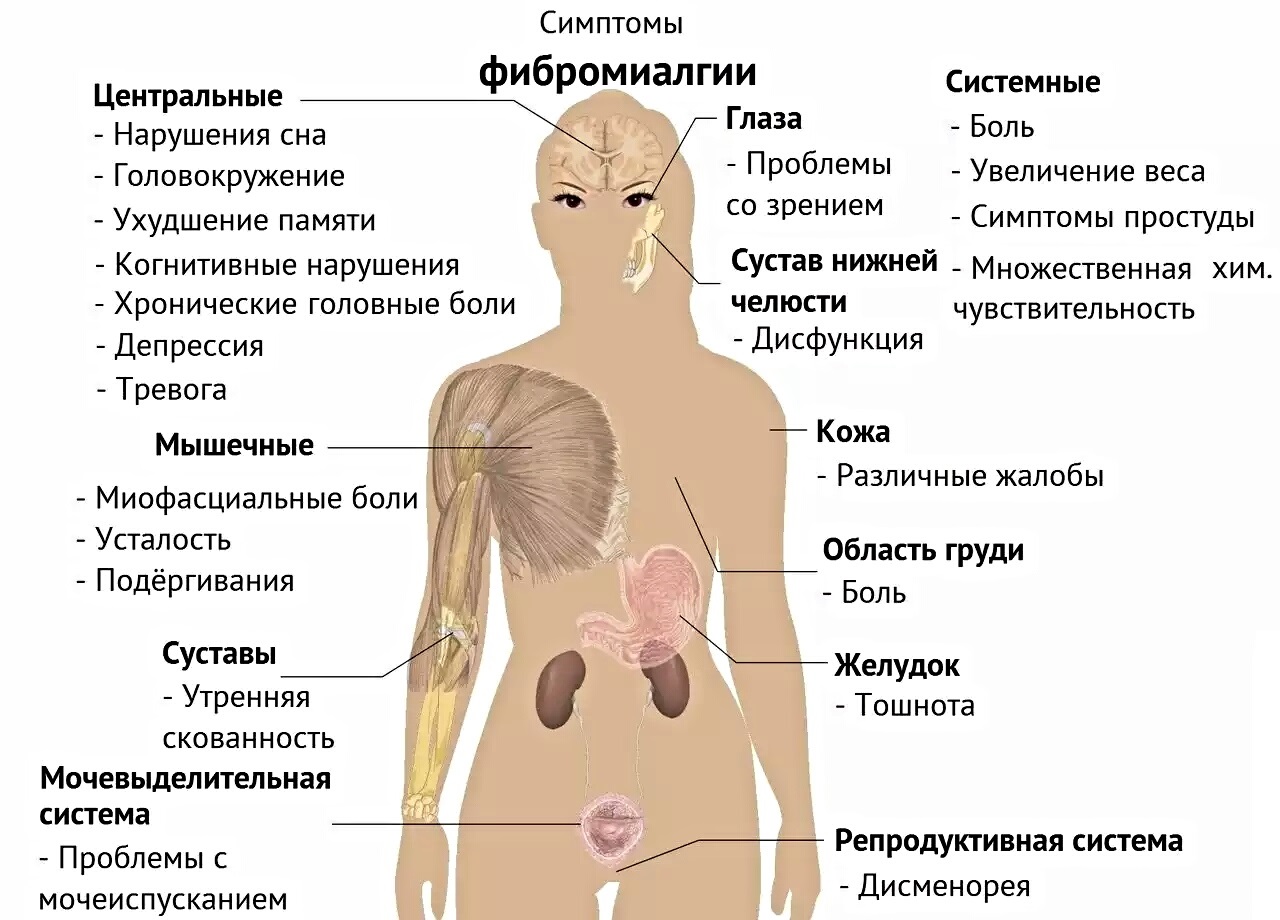 Симптомы фибромиалгии