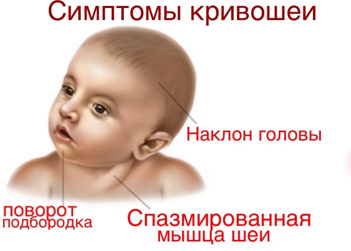 Симптомы кривошеи