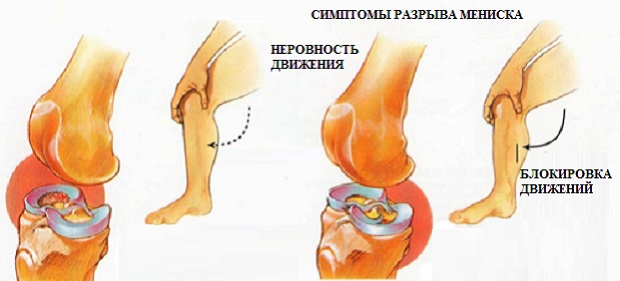 Симптомы повреждения мениска