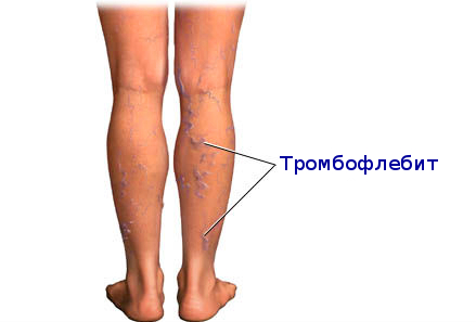 Тромбофлебит – противопоказание к ультразвуковой терапии