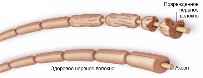 Синдром Гийена-Барре