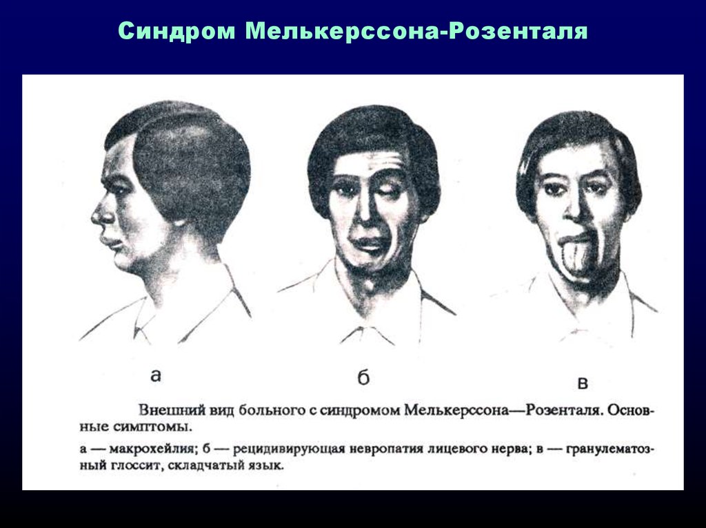 Синдром Мелькерсона-Розенталя