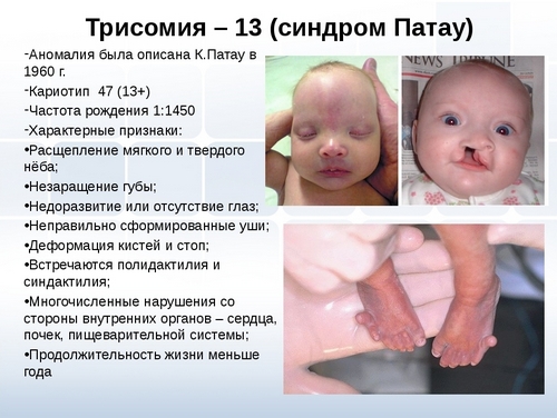 Синдром Патау