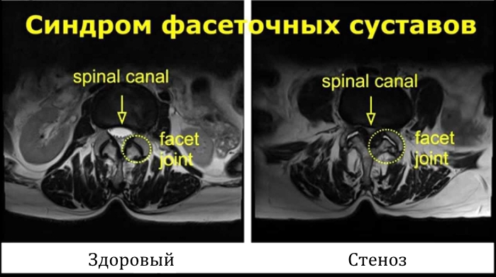 Синдром фасеточных суставов на МРТ