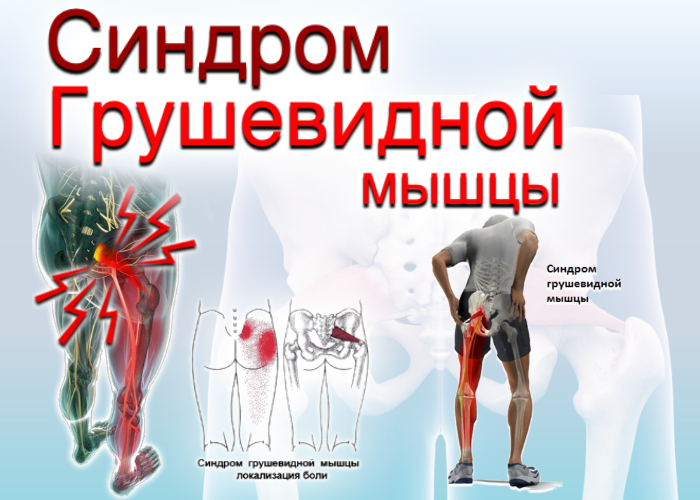 Синдром грушевидной мышцы