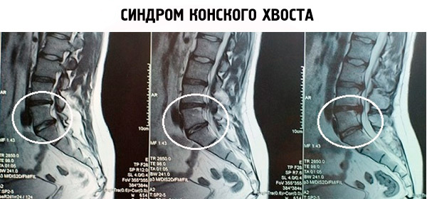 Сдавление нервных корешков конского хвоста на МРТ
