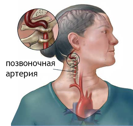 Синдром позвоночной артерии